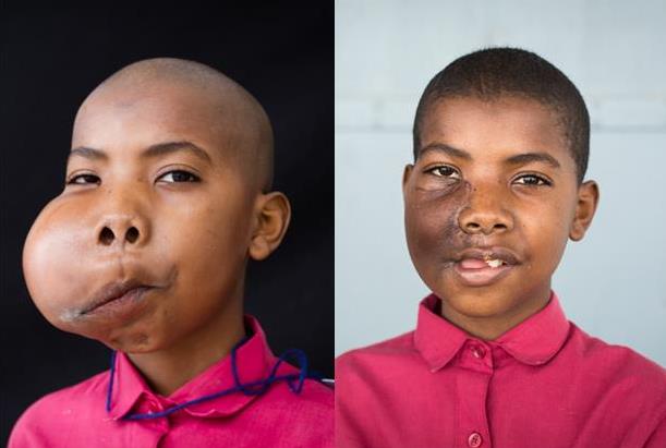 Victorien before and after surgery. Pics; Justine Forrest, Mercy Ships