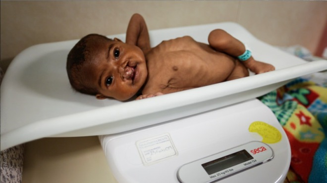 7 mth old Haingo weighed 2.2 kg when she was admitted. Pic Katie Keegan